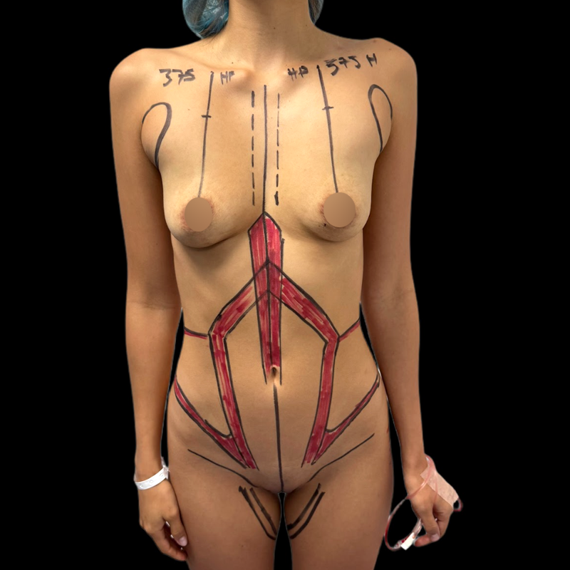 lipohd3