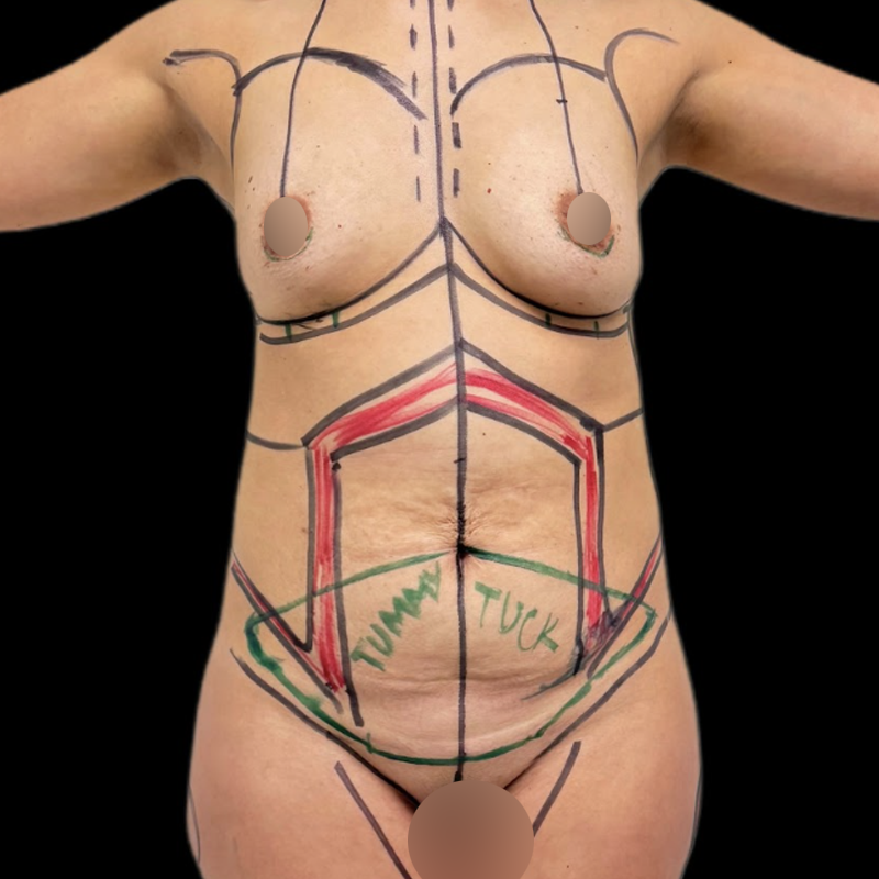 abdominoplastia-4