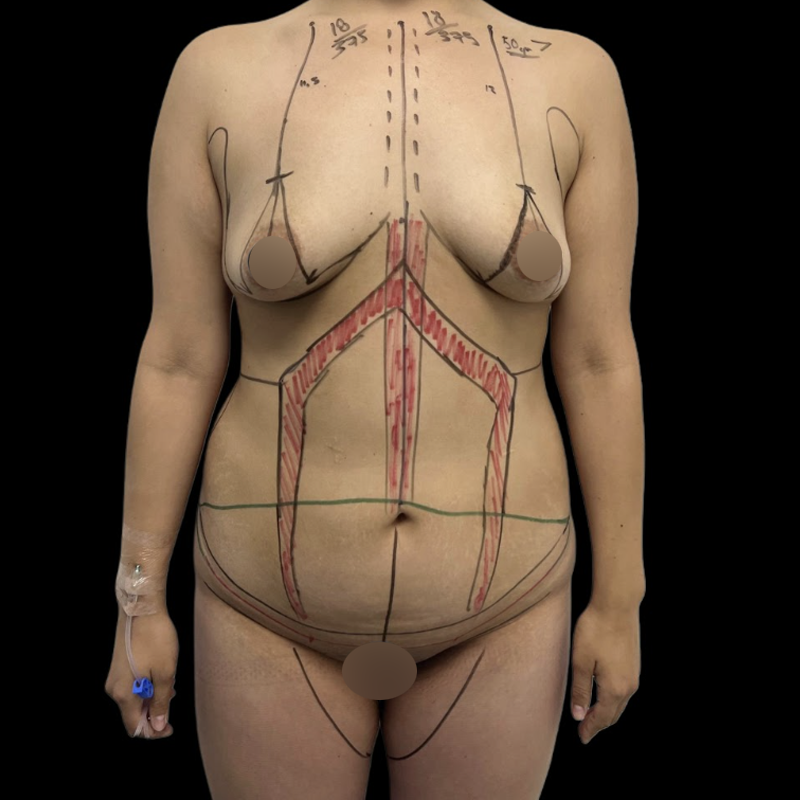 abdominoplastia-5