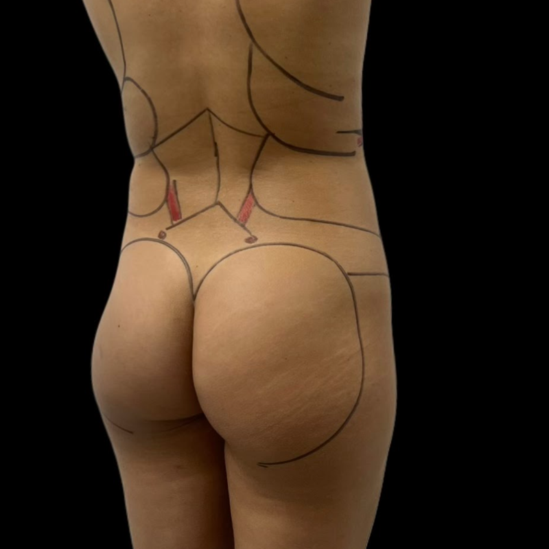 gluteo-6