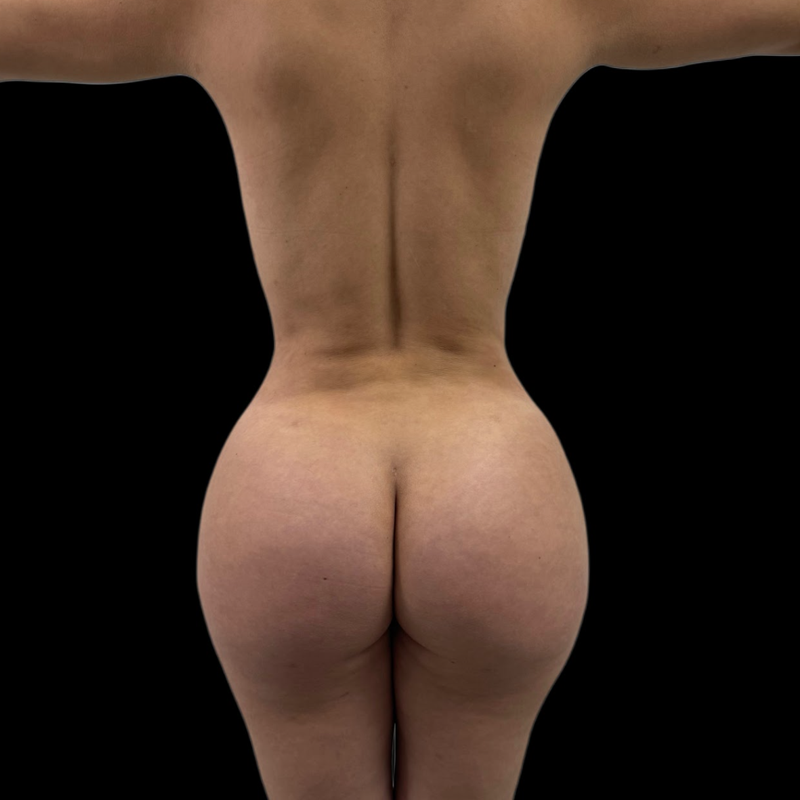 gluteo1