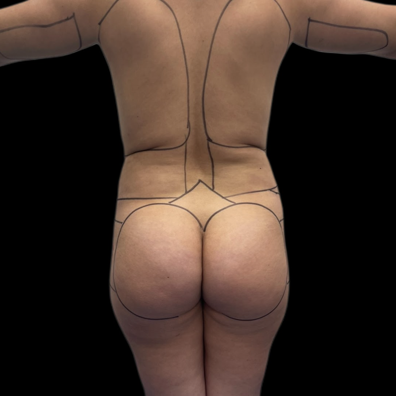 gluteo2