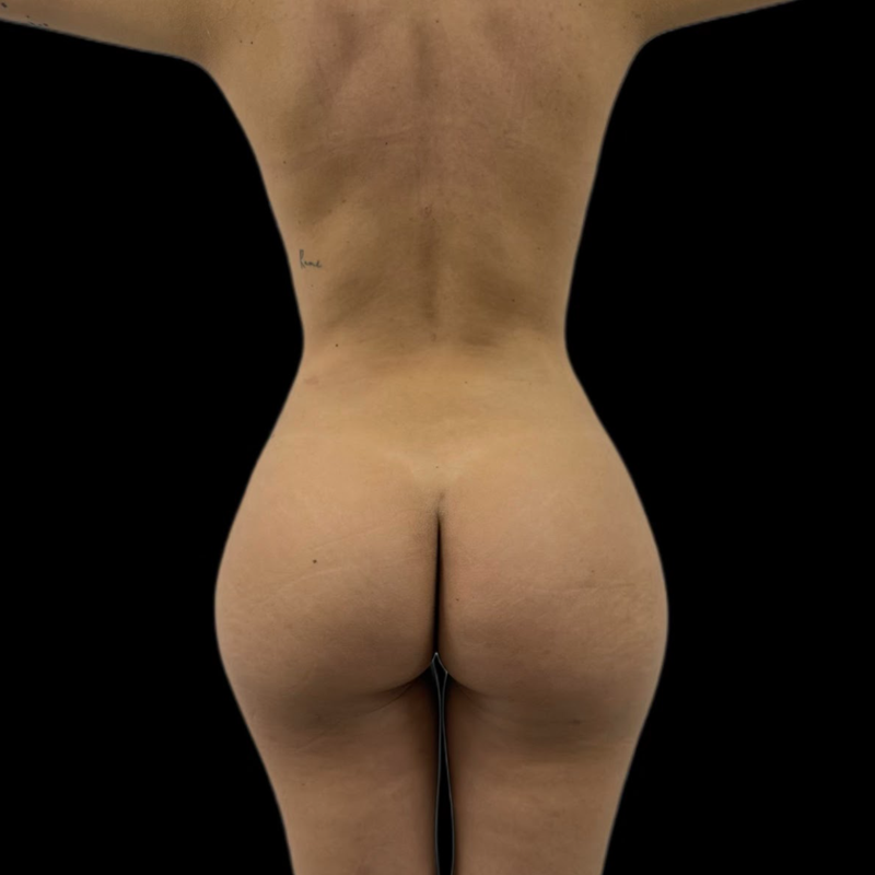 gluteo3