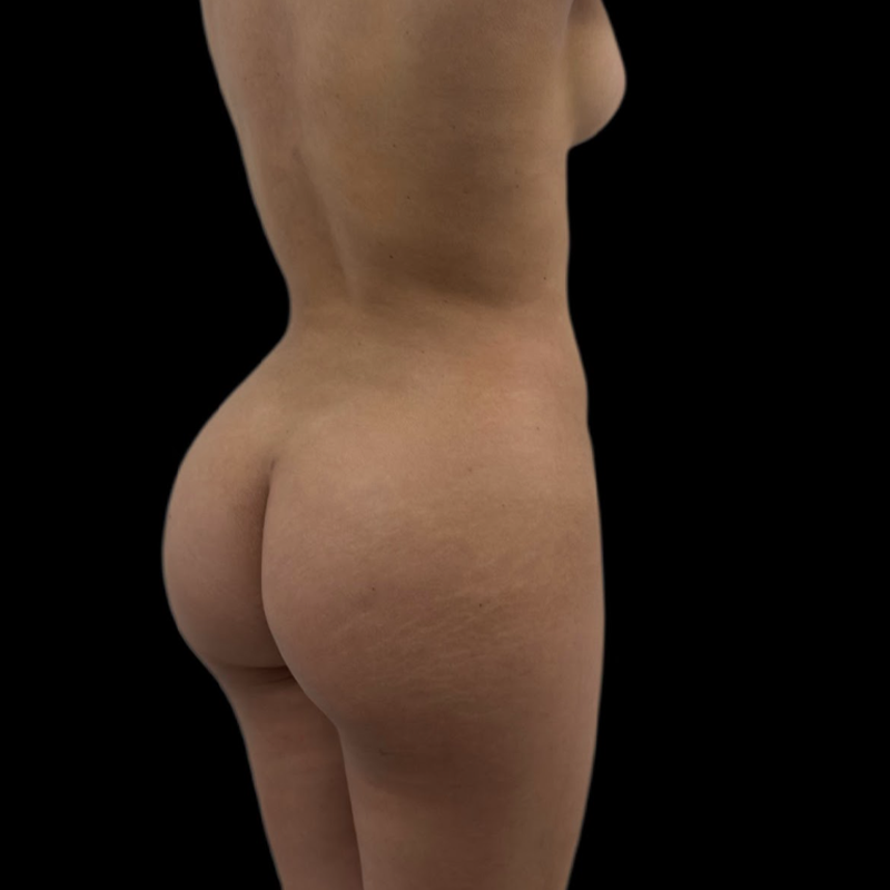 gluteo5