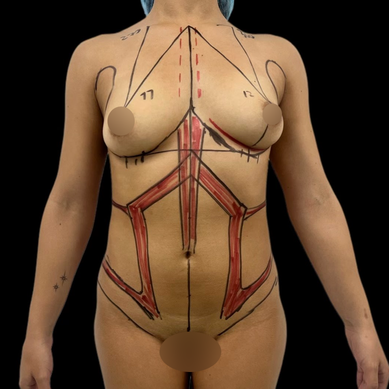 lipo1